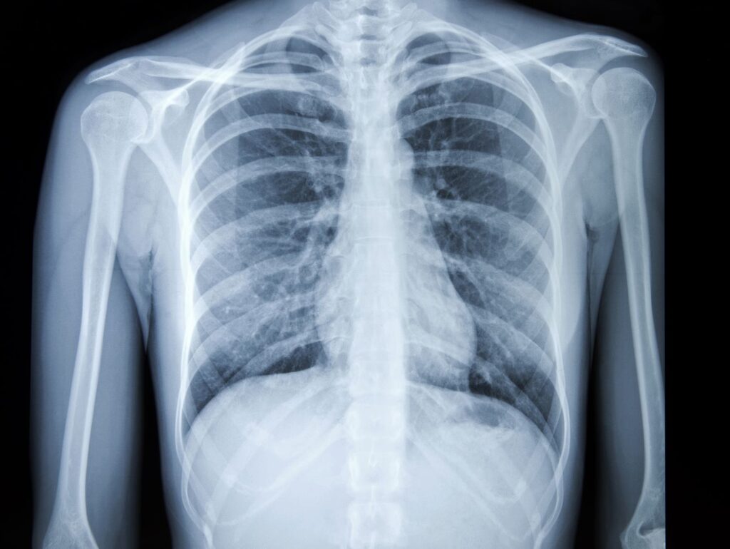 Asbestos related cancers